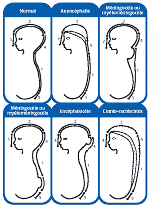 Figure 1. Quelques ATN dues &agrave; des d&eacute;fauts de fermeture du tube neural &agrave; plusieurs endroits. Adaptation de Van Allen, Kalousek et coll., 1993