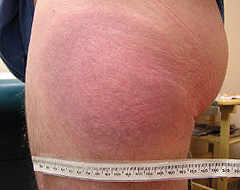 Image of erythema migrans or EM at the site of a tick bite, as shown here on this woman's upper arm.