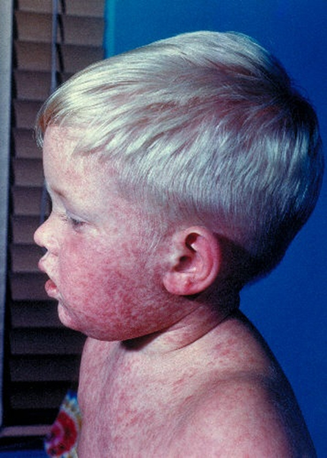 Head and shoulders of boy with measles